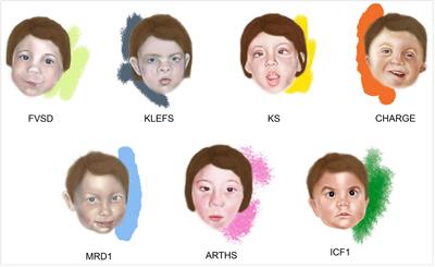 Chromatin Imbalance as the Vertex Between Fetal Valproate Syndrome and Chromatinopathies